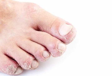 psoriasis