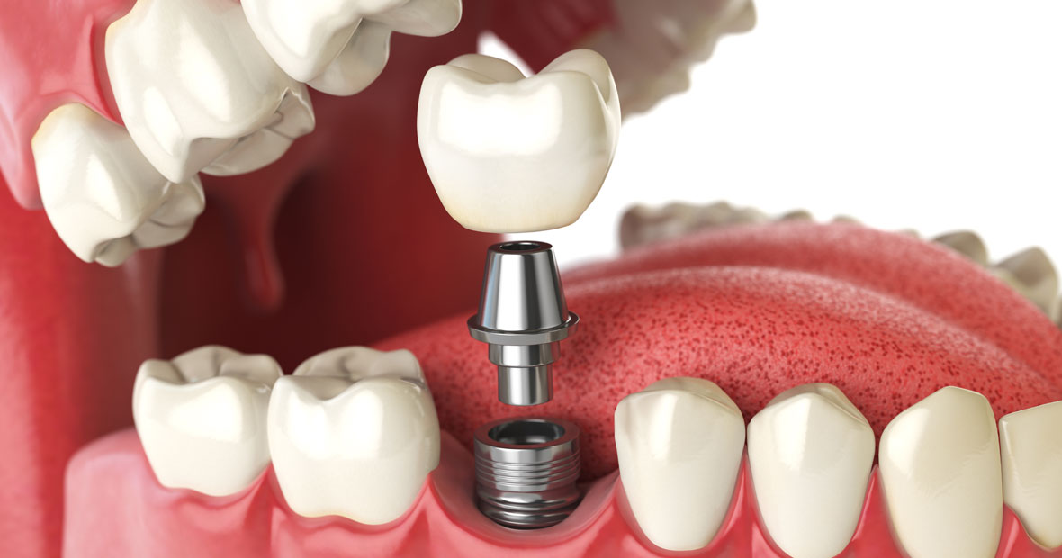 implant dentaire